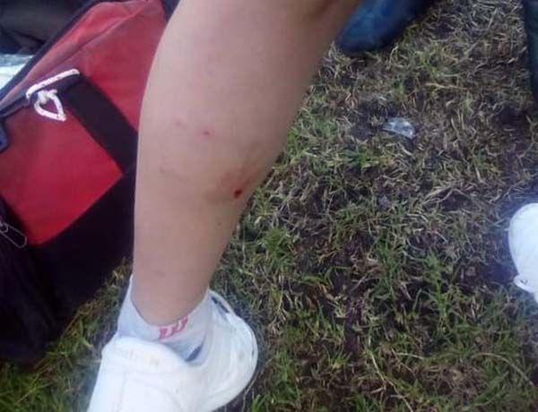 Perro ataca y muerde a niño