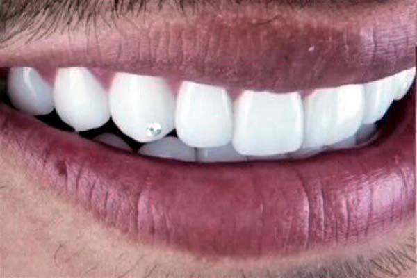 Vega causa revuelo con diamantes en los dientes