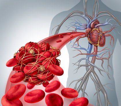 ¿Coágulos en la sangre? Qué es la trombosis, cuáles son sus síntomas y por qué se asocia al covid-19