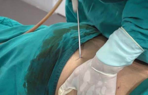 Fallece mujer en liposucción