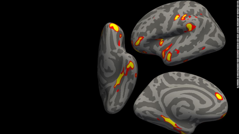 Estudio encuentra que incluso los casos leves de covid-19 producen cambios en el cerebro