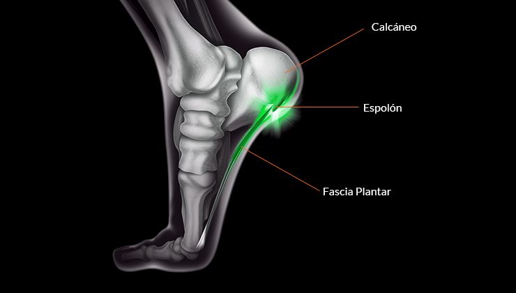 4 Ejercicios para tratar el espolón calcáneo