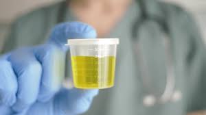 El revolucionario hallazgo que vincula el cáncer de próstata con bacterias en la orina