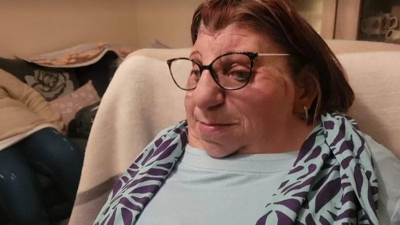Vivir con síndrome de Treacher Collins, la extraña enfermedad que afecta el desarrollo facial
