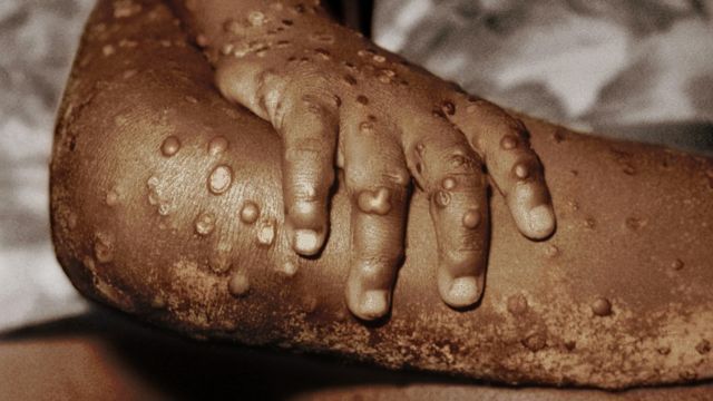 Viruela del mono: en qué se diferencia de la devastadora viruela humana