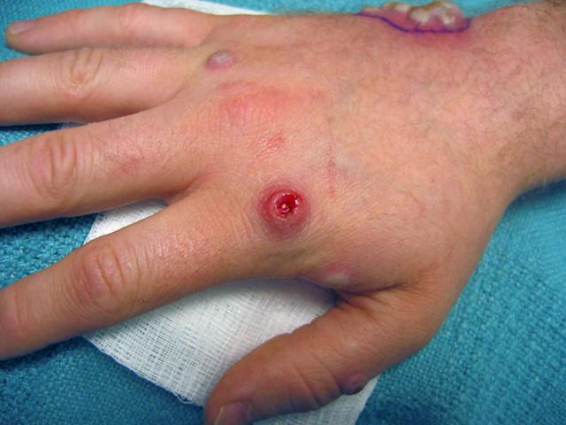 ¿Quién está protegido contra la viruela del mono?, experto lo esclarece