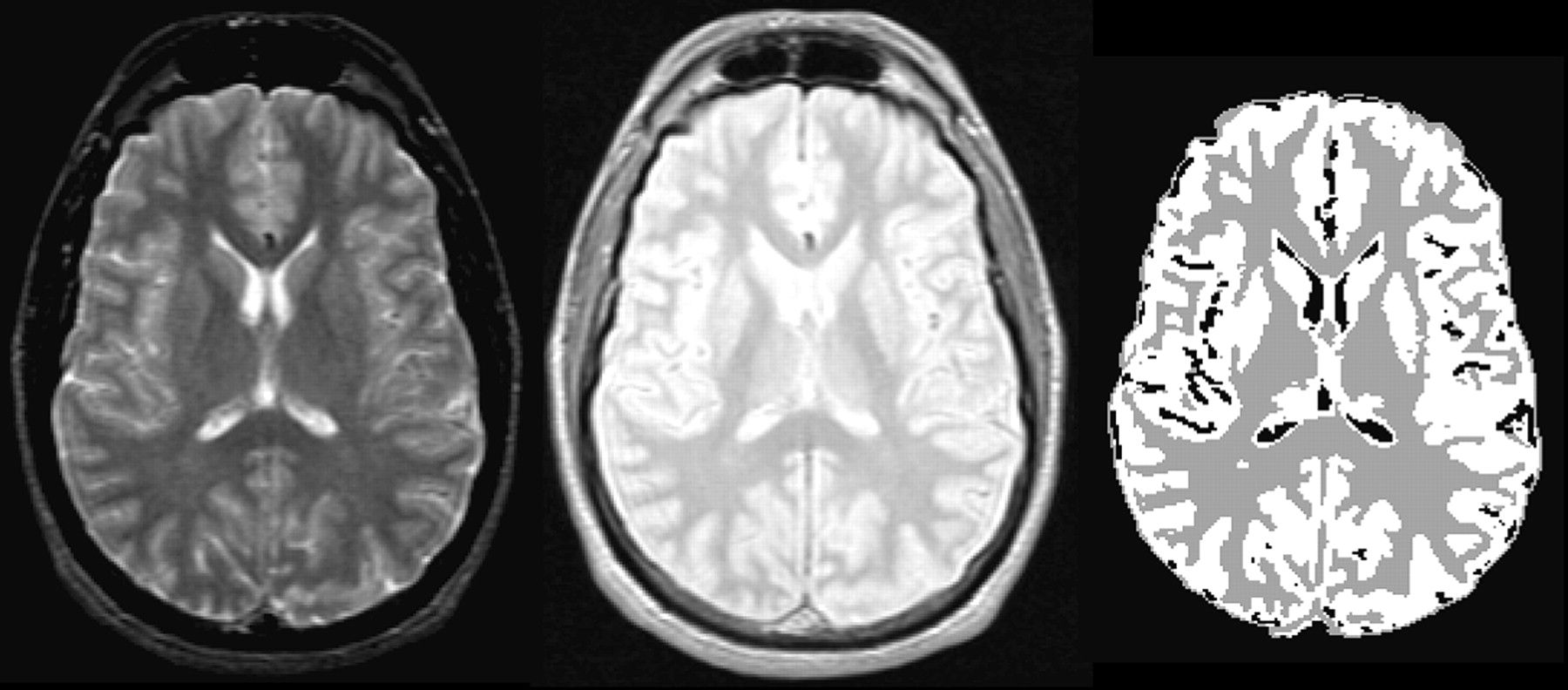 Qué es la materia blanca que compone la mitad de nuestro cerebro (y en qué se diferencia de la materia gris)