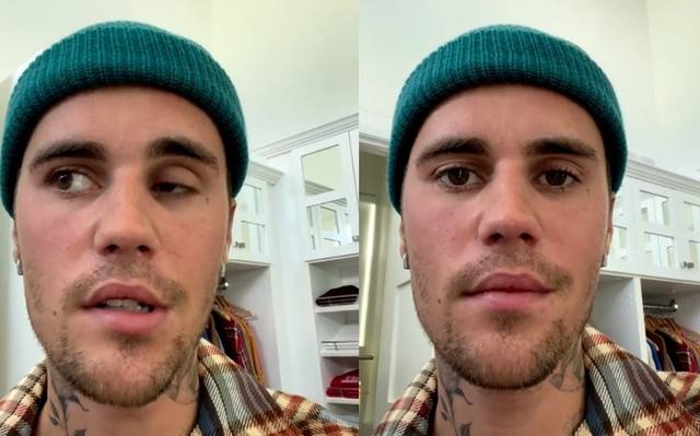 ¿Qué es el síndrome de Ramsay Hunt?, la enfermedad que padece Justin Bieber