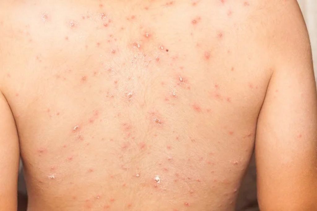 ¿Erupciones por viruela del mono, dejan cicatrices?