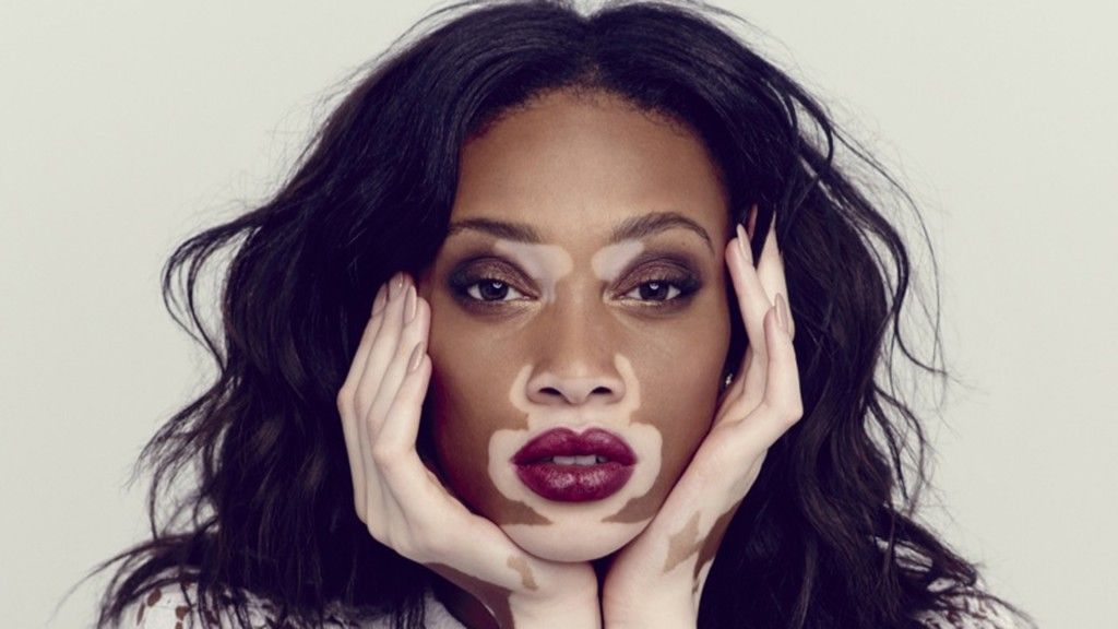 ¿Qué es el vitiligo? Estos son los síntomas y la población a la que afecta
