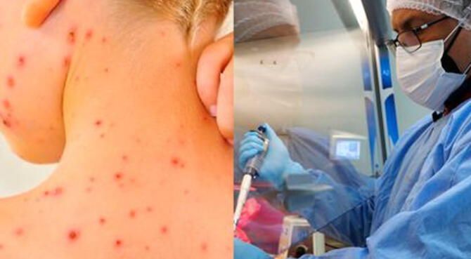 El brote de viruela del mono debe tomarse más en serio ya que el virus continúa propagándose