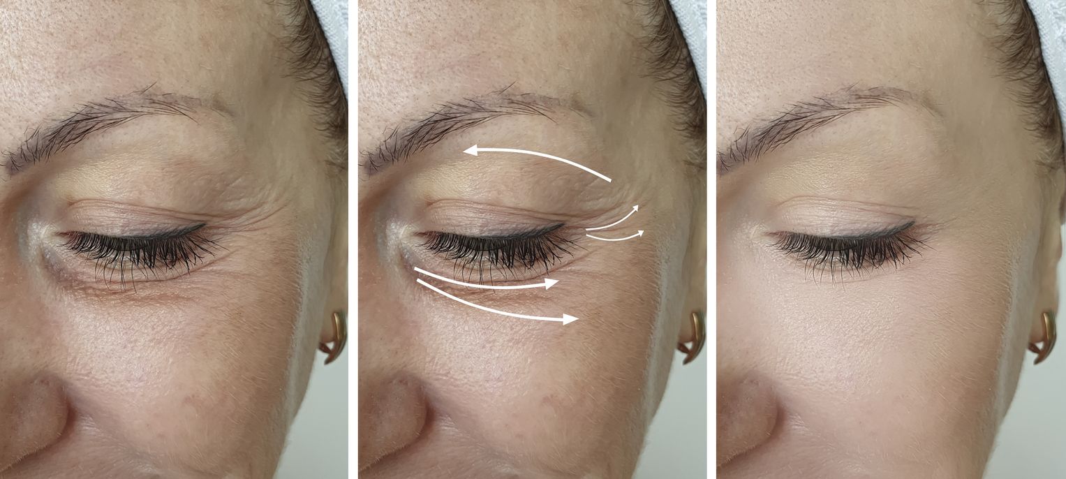 Remedios naturales para tratar la resequedad del contorno de ojos