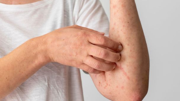 ¿Quiénes son más vulnerables frente a una infección por viruela del mono?