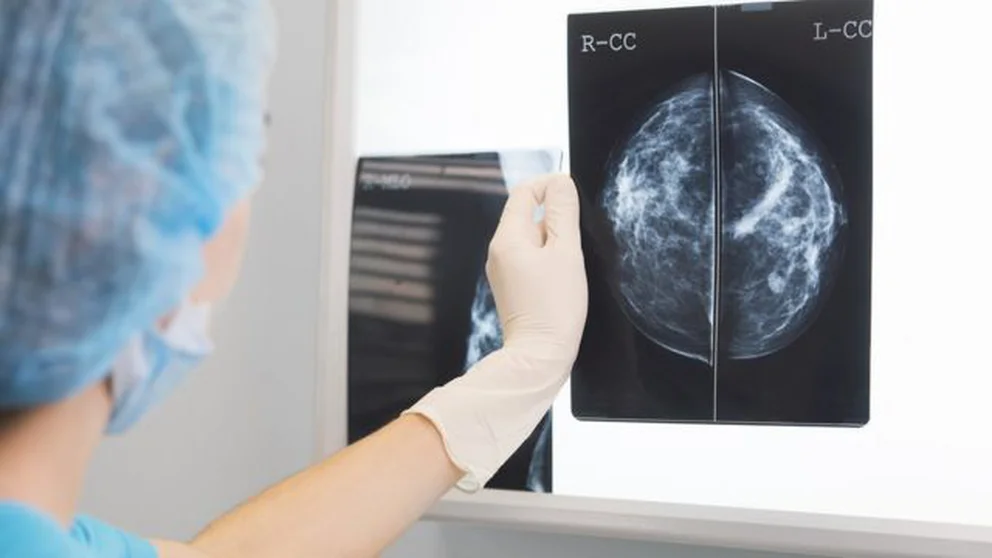 Así funciona la inteligencia artificial que es capaz de detectar más rápido el cáncer de mama