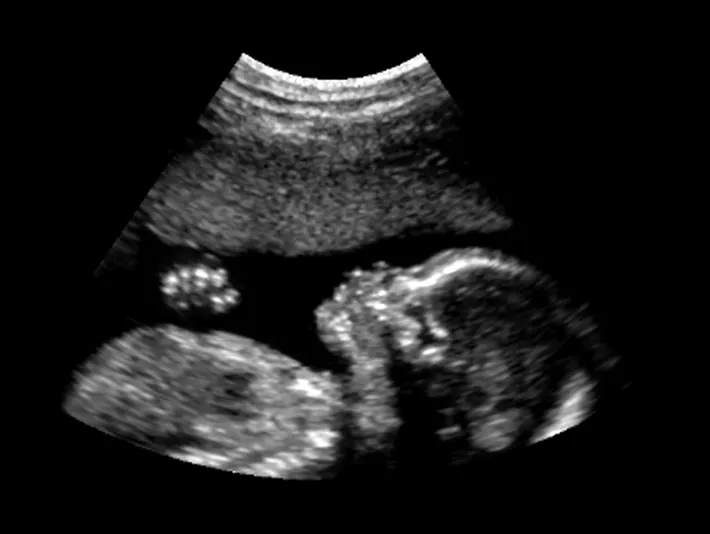 Trastorno del espectro alcohólico fetal: qué es y cuáles son sus consecuencias