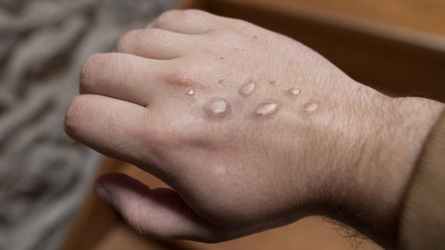 Viruela del mono: cuál es el perfil de los infectados y cómo puede cambiar a medida que avanza la enfermedad