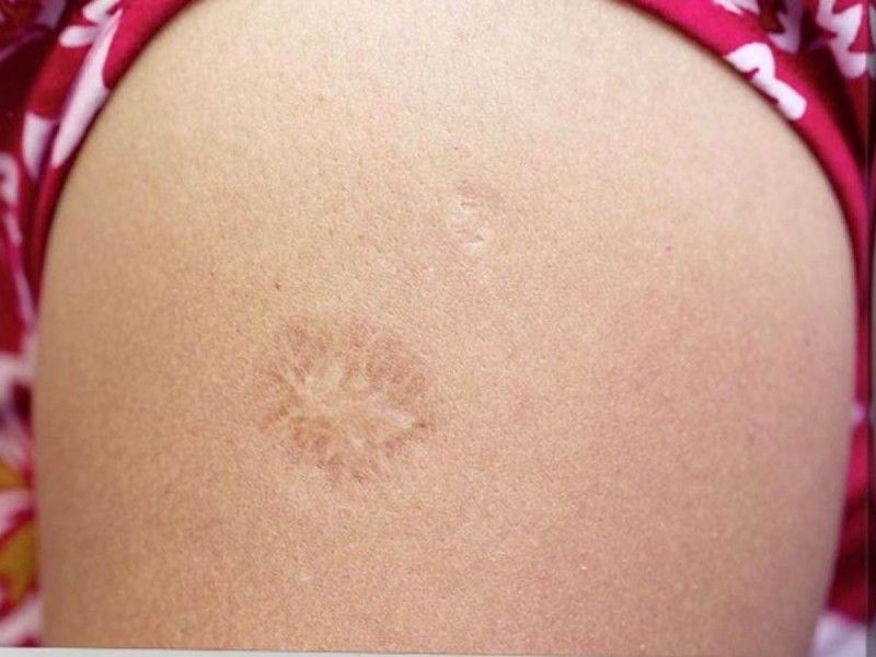 ¿Tienes esta cicatriz en el brazo? Podrías ser inmune a la viruela del mono