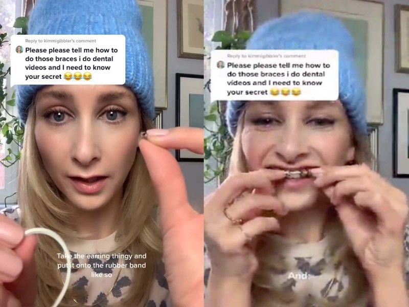 Ligas en los dientes, la nueva moda muy peligrosa en Tik Tok