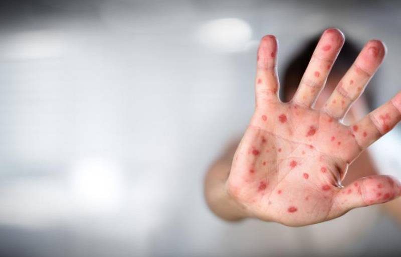 Gripe del tomate: la nueva enfermedad en India que infecta a niños y niñas