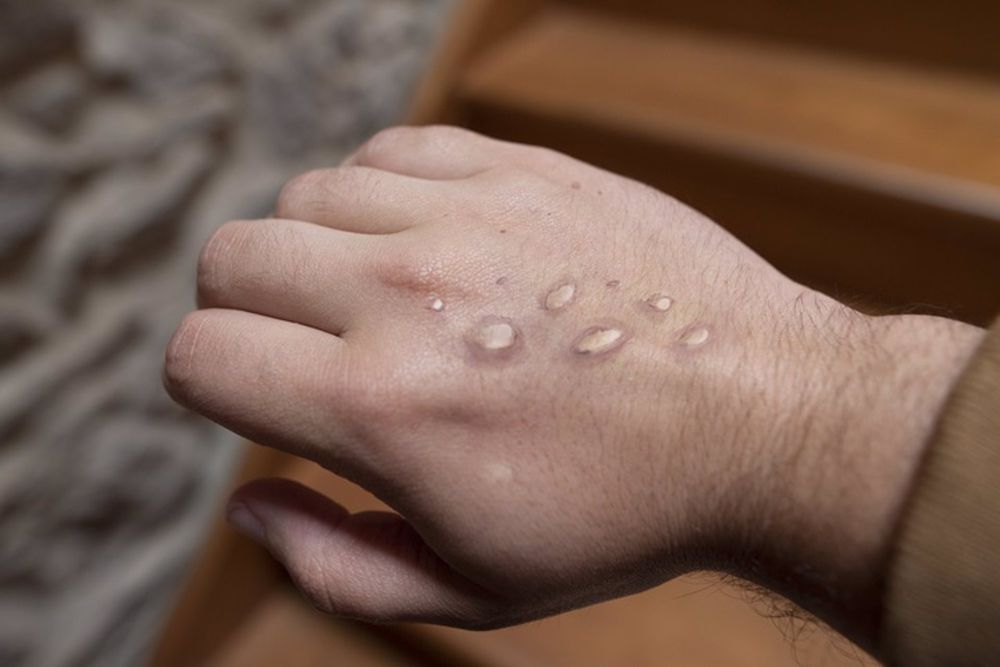 Transmisión principal de viruela del mono es por contacto de piel: dermatólogos