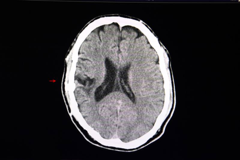 ¿Cómo detectar que está ocurriendo un derrame cerebral?