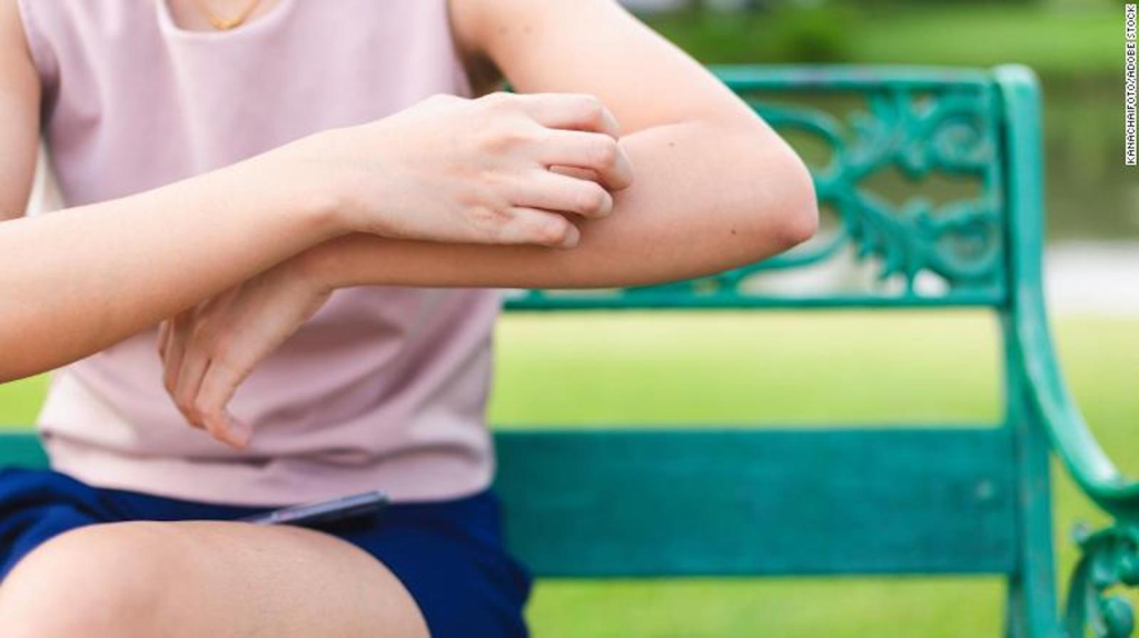 Qué hace que las picaduras de mosquitos piquen y qué hacer al respecto