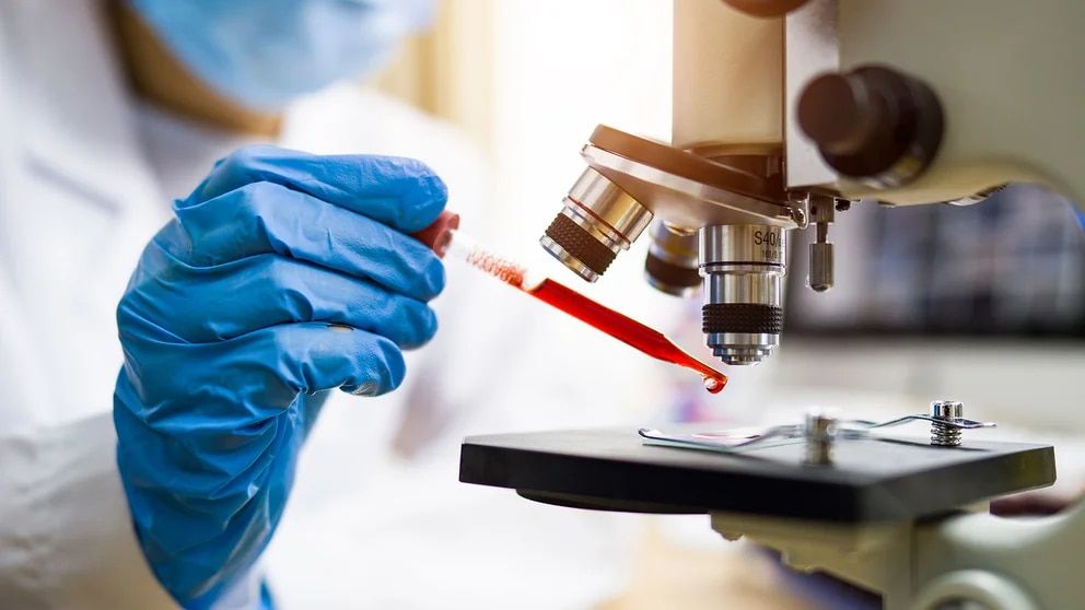 Cómo es el análisis de sangre para tumores difíciles de detectar como los linfomas, los hepáticos y de páncreas