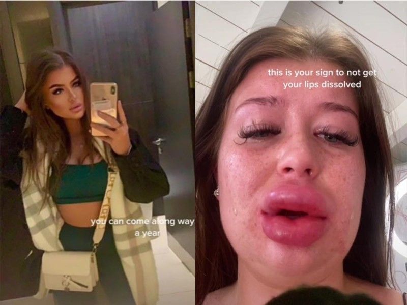 Karli Gardner: Así quedó cara de modelo tras inyectarse relleno de labios