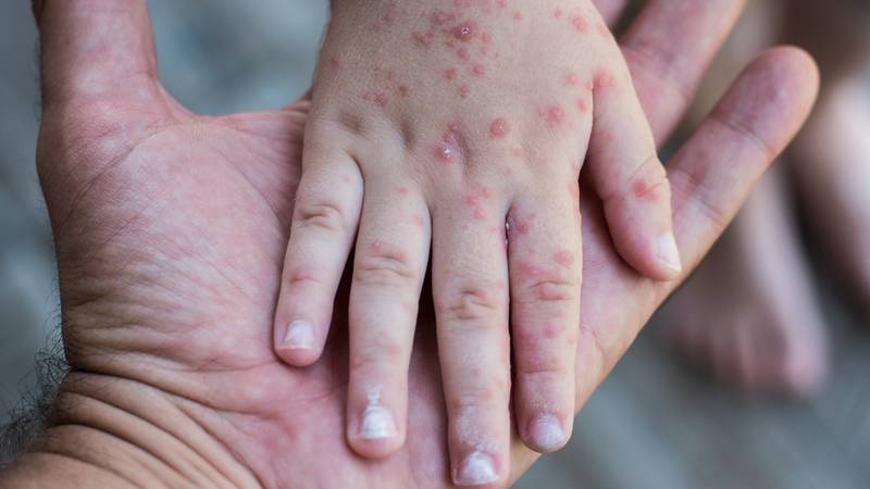 Virus de coxsackie: ¿Cómo se contagia y cuáles son los síntomas?