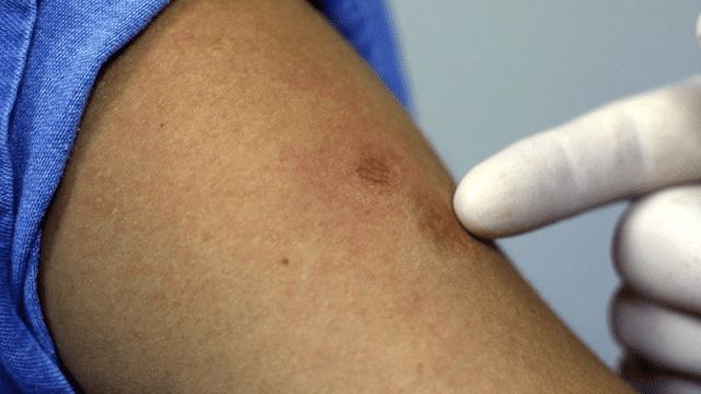 Viruela del mono, relacionada con la encefalitis en brotes anteriores