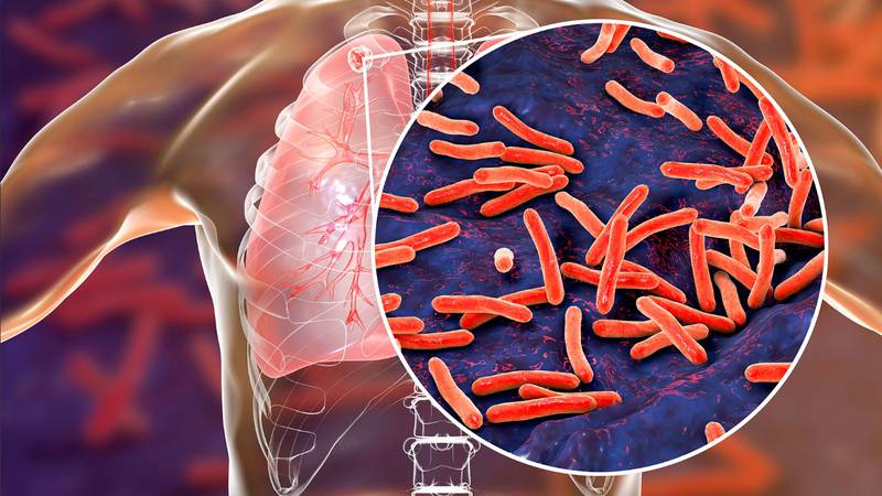 Casos de tuberculosis empeoran, según la OMS: Estos son los síntomas