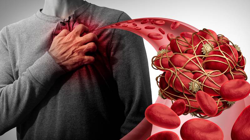 Trombosis: Estos son los síntomas a los que debes estar alerta