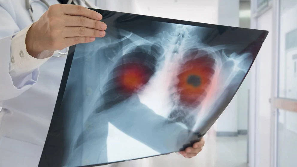 Qué rol juega la inflamación pulmonar en el COVID prolongado