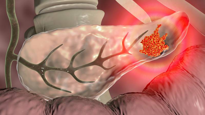 Día Mundial del Cáncer de Páncreas: ¿Cuáles son los síntomas y causas de su aparición?