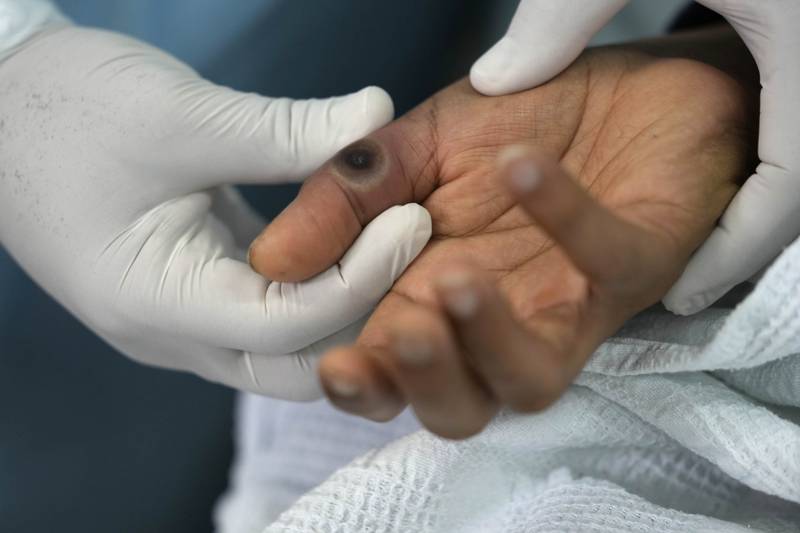 Viruela del mono: Investigadoras advirtieron que mpox se convertiría en un problema global
