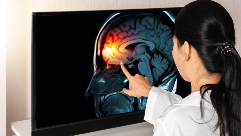 Meningitis aséptica: Estos síntomas indican un cuadro grave de la enfermedad