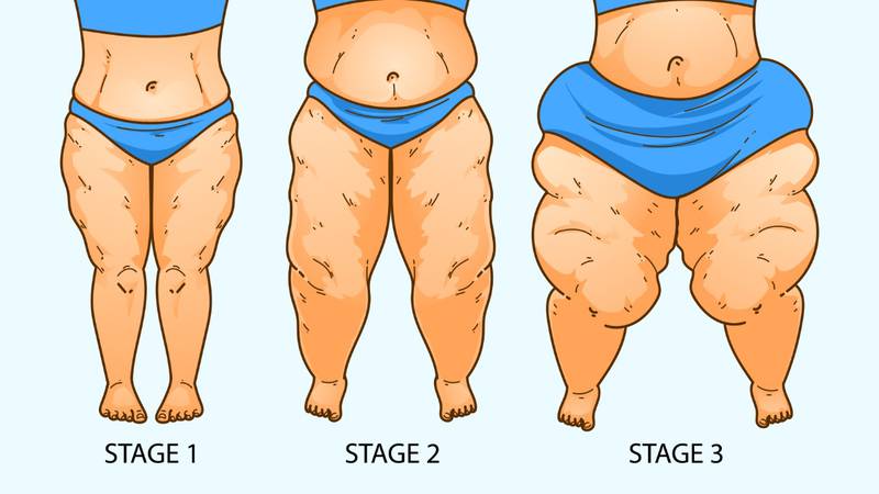 Lipedema: ¿Qué es y cuáles son sus síntomas?
