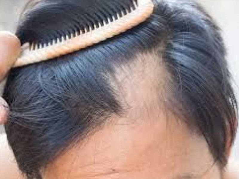 ¿Tienes calvicie? ¡Cuidado con los trasplantes capilares!, pueden ser mortales