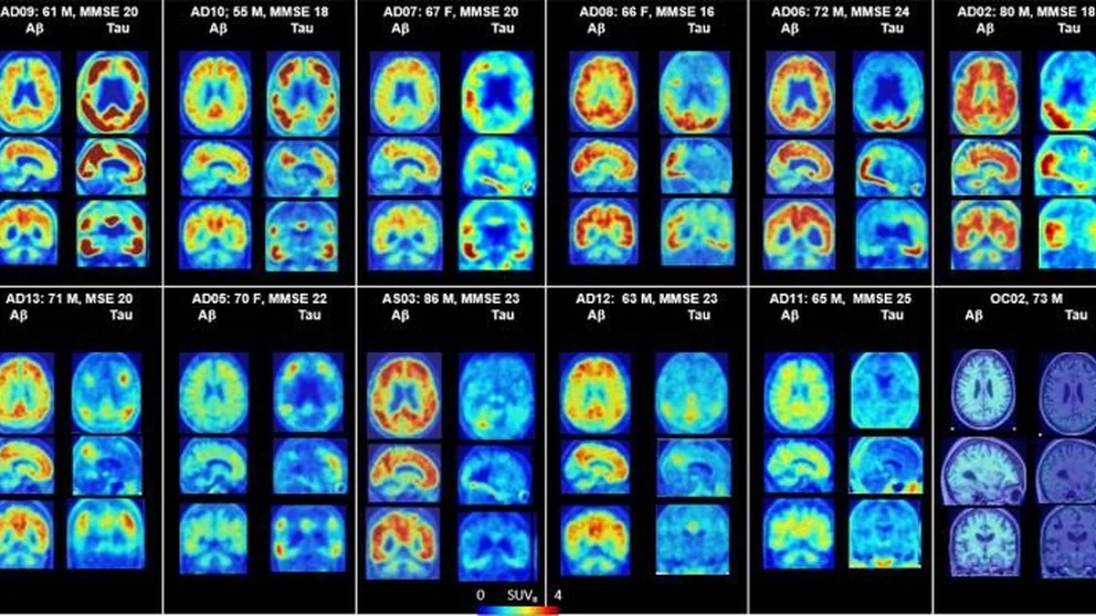 ¿Qué tan determinante es conocer el riesgo genético de desarrollar Alzheimer?