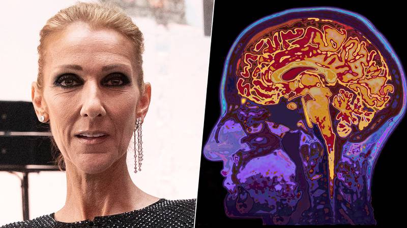 ¿Qué es el síndrome de la persona rígida, enfermedad que padece Celine Dion?