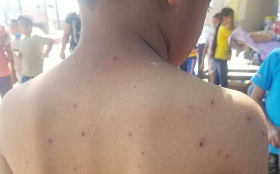 Brote de varicela ‘preocupa’ a Tamaulipas: ¿Cómo se contagia y cuáles son sus síntomas?