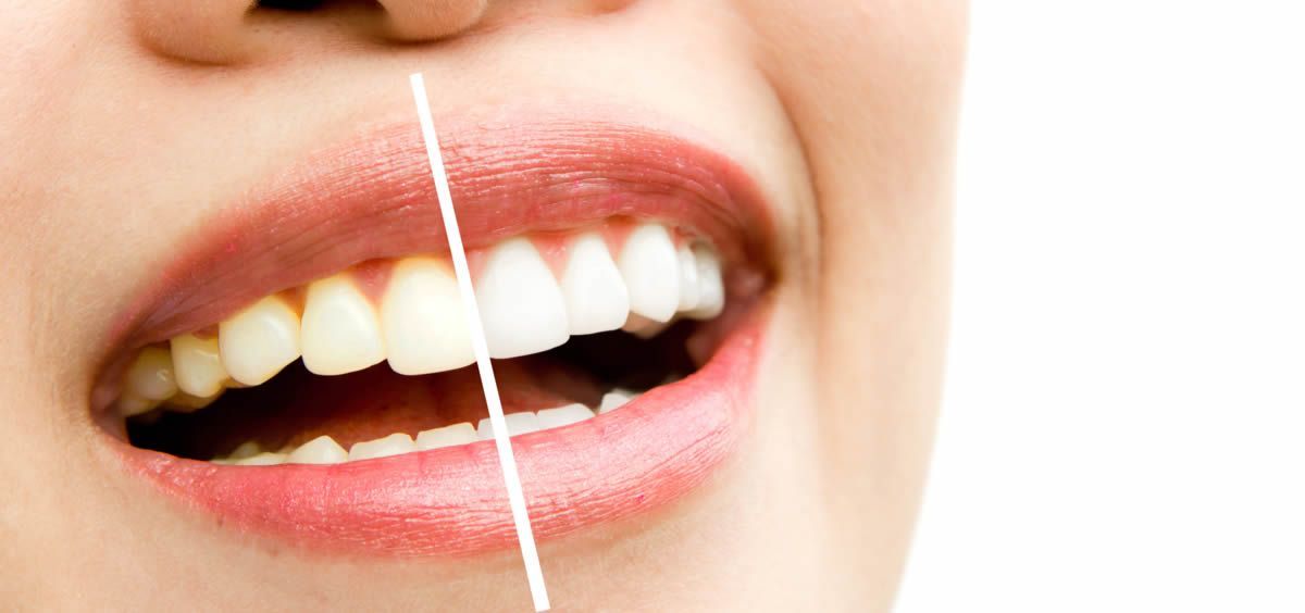 Blanqueamiento dental natural: el tratamiento definitivo para lucir una sonrisa bonita