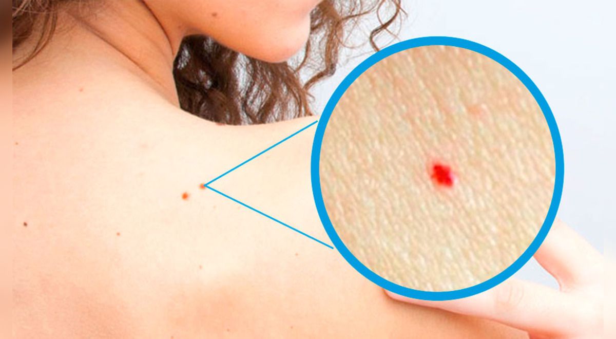 ¿Lunares o manchitas rojas en la piel? Esto es lo que debes saber sobre ellos