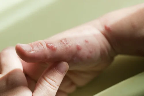 ¿Qué es el herpes, la enfermedad que padece el 70% de la población mundial?