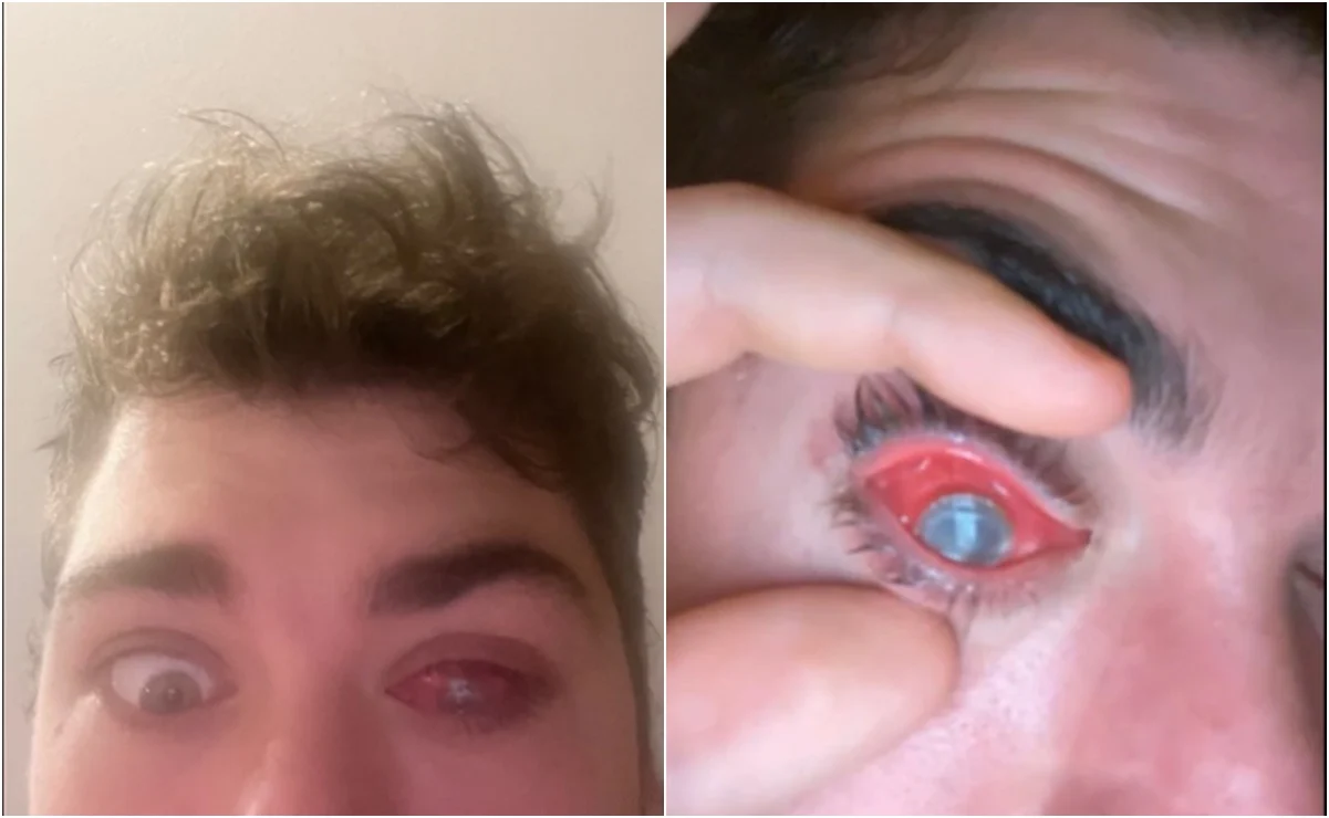 TikTok: Joven olvida quitarse lentes de contacto para tomar siesta y casi pierde un ojo