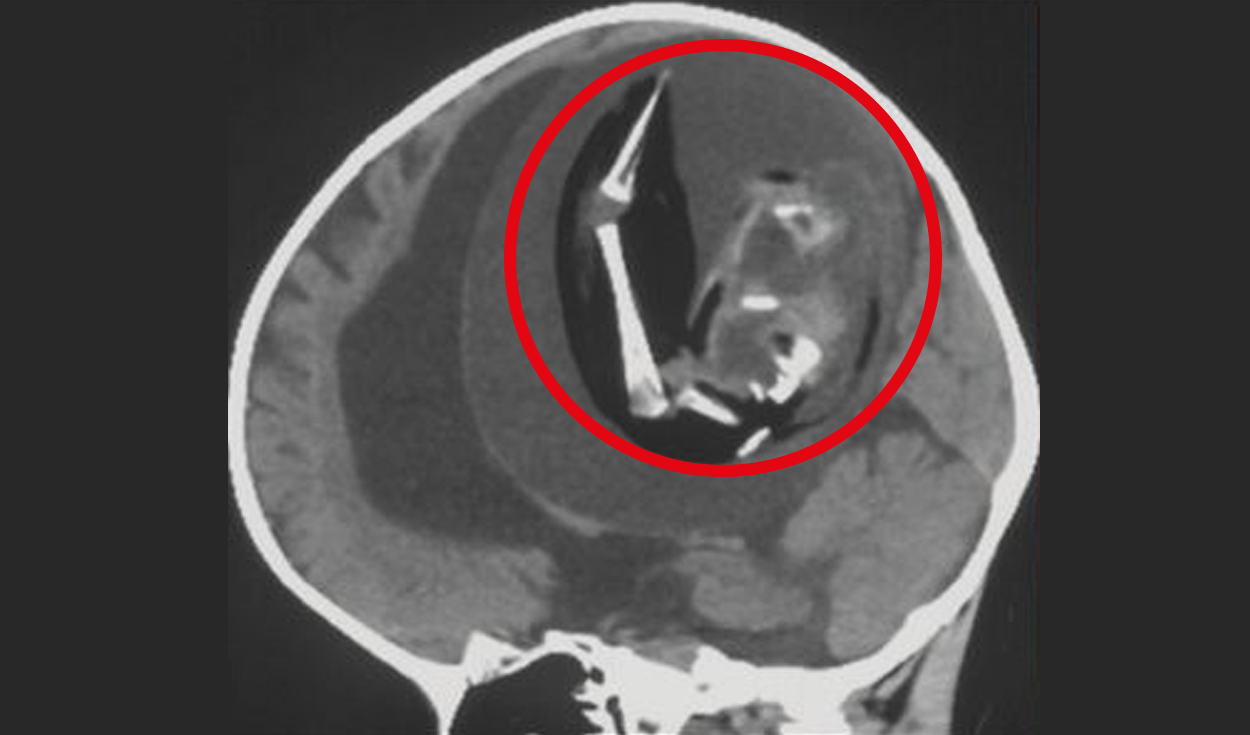 Extraen el feto vivo de un niño del cerebro de su hermana melliza
