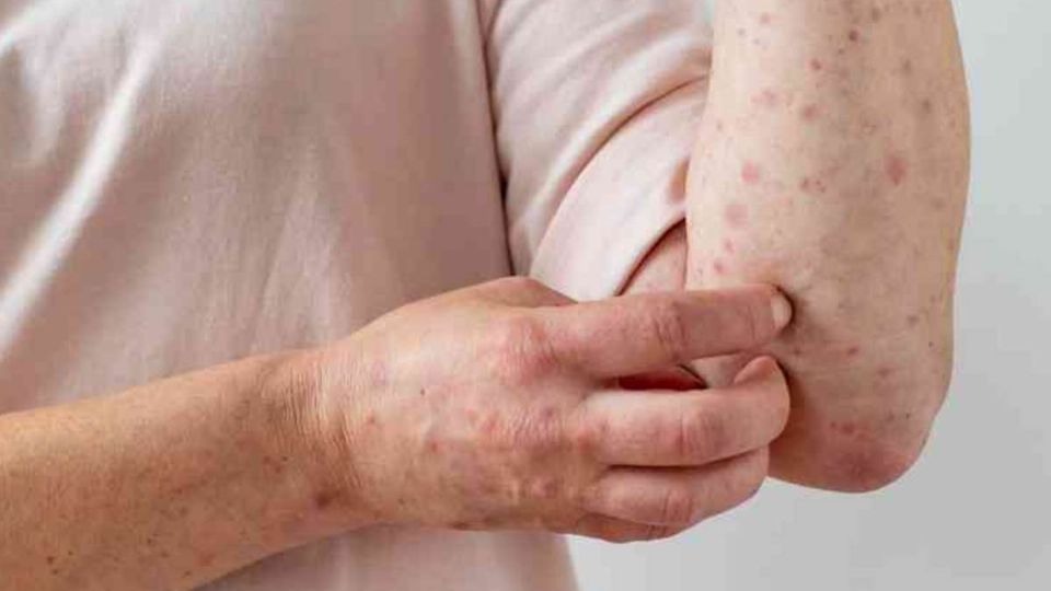 ¿Qué es el Mpox? Así se contagia la enfermedad que ya cobró 5 vidas en México