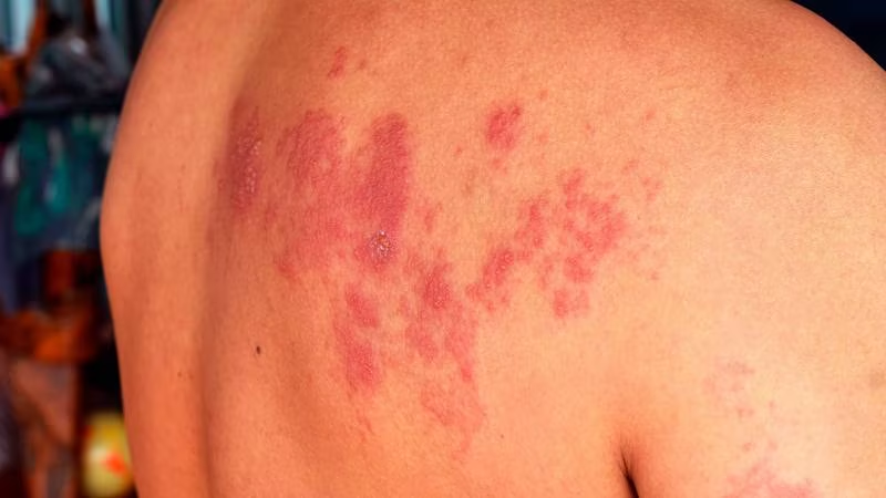 ¿Por qué todos debemos vacunarnos contra el herpes zóster?