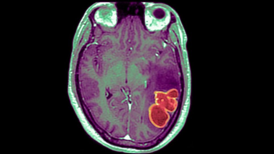 Emergencia de salud: médicos alertan por una fuerte infección cerebral en niños de EU