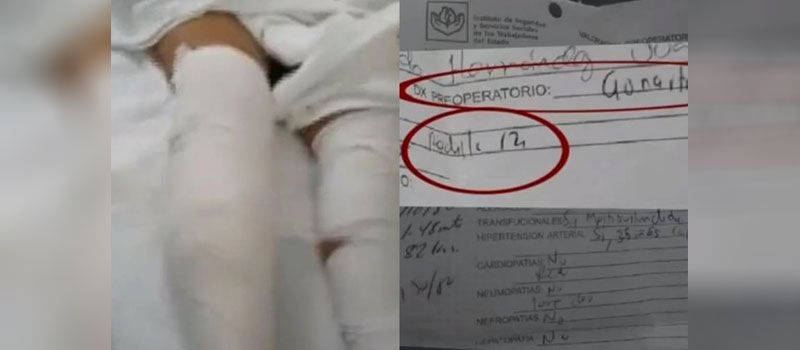 ISSSTE le opera la pierna equivocada a una mujer y ahora no puede con el dolor en SLP